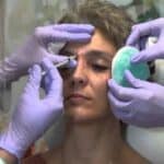 Mračna strana botoksa: Šta vam nisu rekli