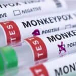 U Nemačkoj pronađen novi soj virusa Majmunskih boginja