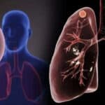 SZO upozorava da je najsmrtonosnija infekcija na svetu na rekordnom nivou