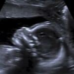 Abortus je bio vodeći globalni uzrok smrti 2024. sa preko 45 miliona nerođenih beba