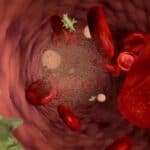 Hiljade žena u Velikoj Britaniji koje su bile potpuno vakcinisane pate od „agresivnog“ raka krvi