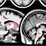 Velika studija upozorava: Vakcinisani protiv Kovida izloženi dugoročnom riziku od oštećenja mozga