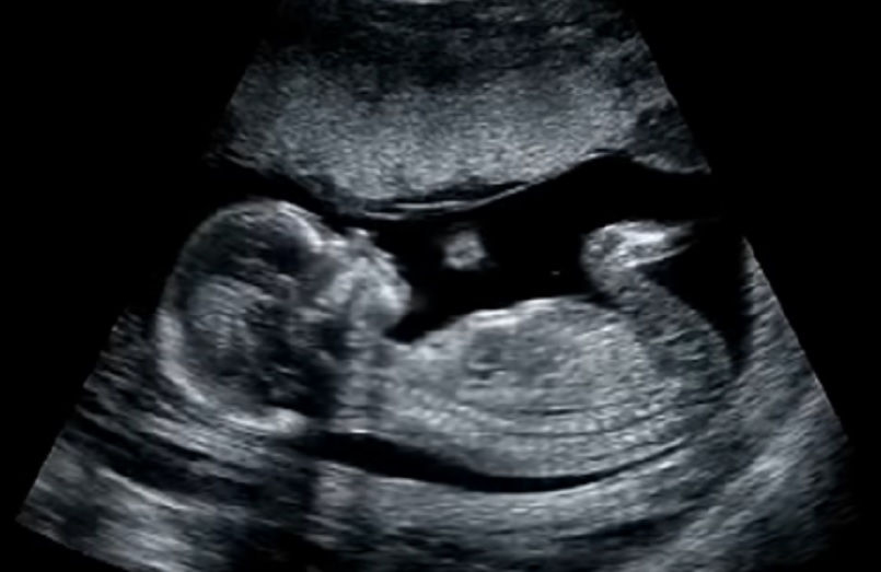 SZO: Abortusi su izbrisali skoro trećinu generacije širom sveta