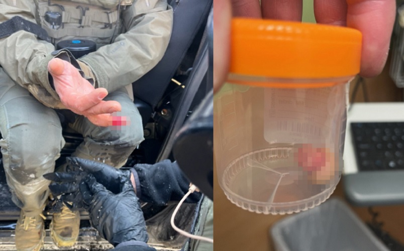 Jezivo: Federalni agent ostao bez prsta nakon što ga je pomahnitali levičarski demonstrant odgrizao