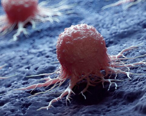 РАК ИЗМИЧЕ КОНТРОЛИ: 30,5 МИЛИОНА НОВИХ ОБОЛЕЛИХ ДО 2050. – СВЕТ УЛАЗИ У ЗДРАВСТВЕНИ КОЛАПС