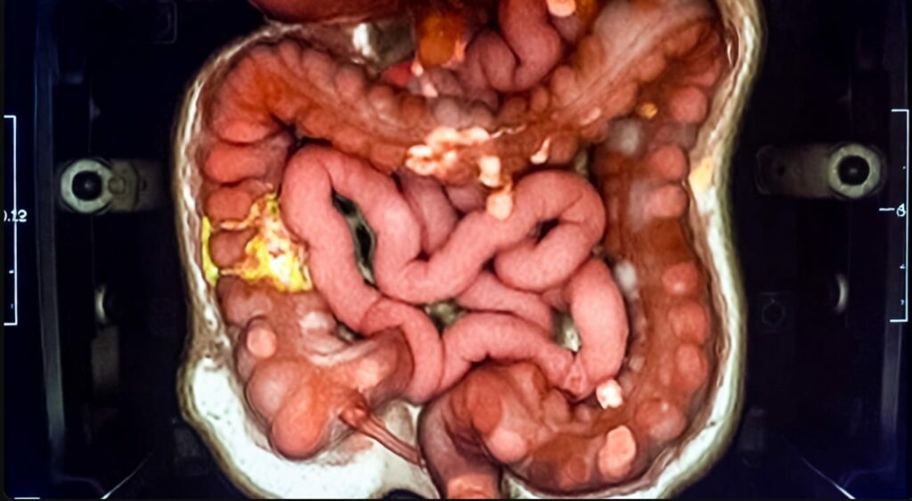 Savremeni lekovi za mršavljenje dovode do eksplozije Debelog Creva - Majk Adams