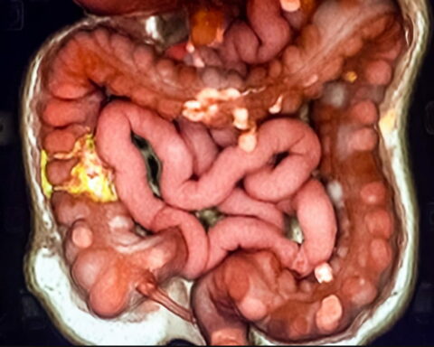 Savremeni lekovi za mršavljenje dovode do eksplozije Debelog Creva - Majk Adams