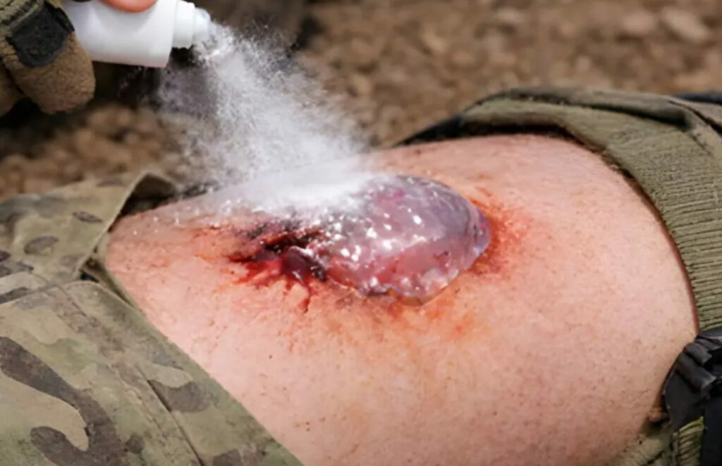 REVOLUCIJA U MEDICINI: Sprej koji zaustavlja krvarenje za jednu sekundu