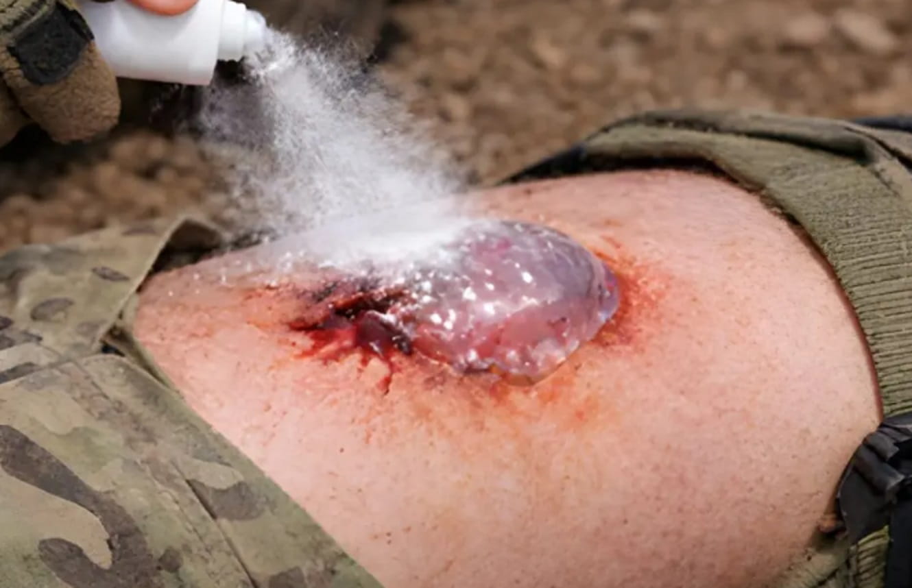 REVOLUCIJA U MEDICINI: Sprej koji zaustavlja krvarenje za jednu sekundu